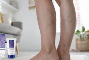 varicose veins stages