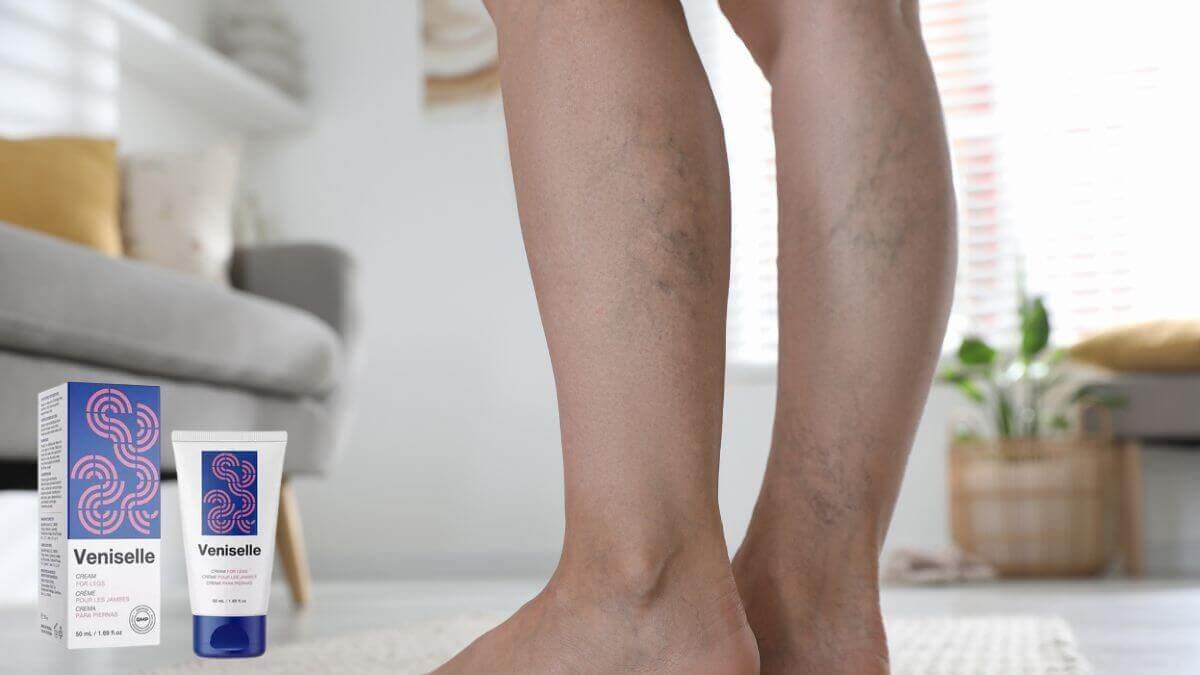 varicose veins stages