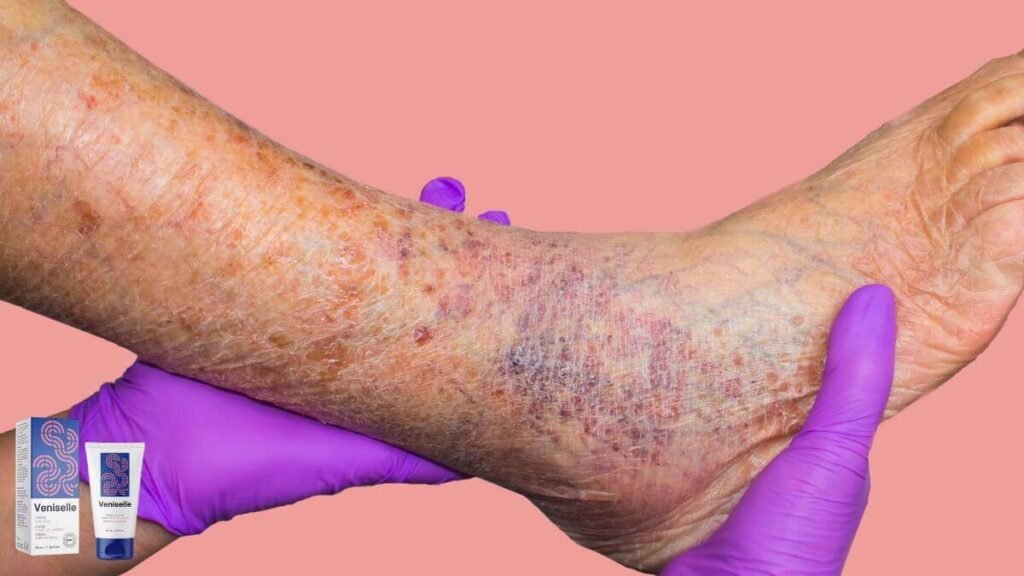 varicose veins treatment cream