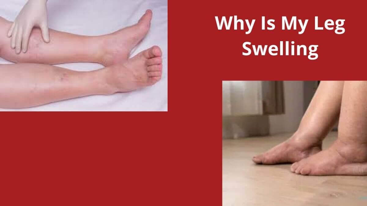 Why Is Only My Left Leg Swelling
