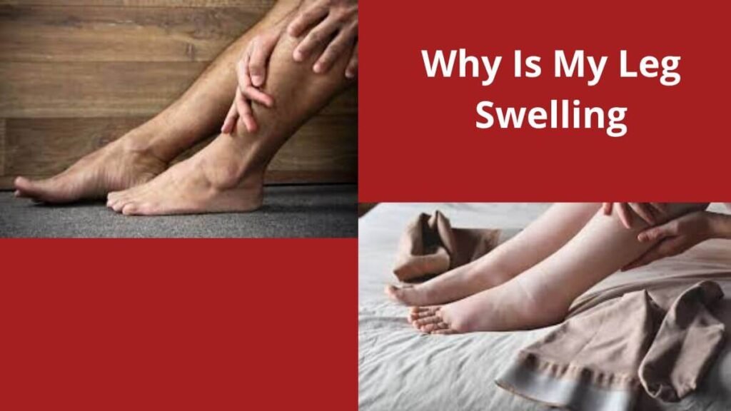 Why is my leg swelling so much