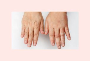 why do my hands swell when i walk