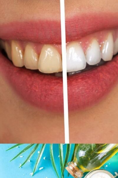 does coconut oil whiten teeth 6
