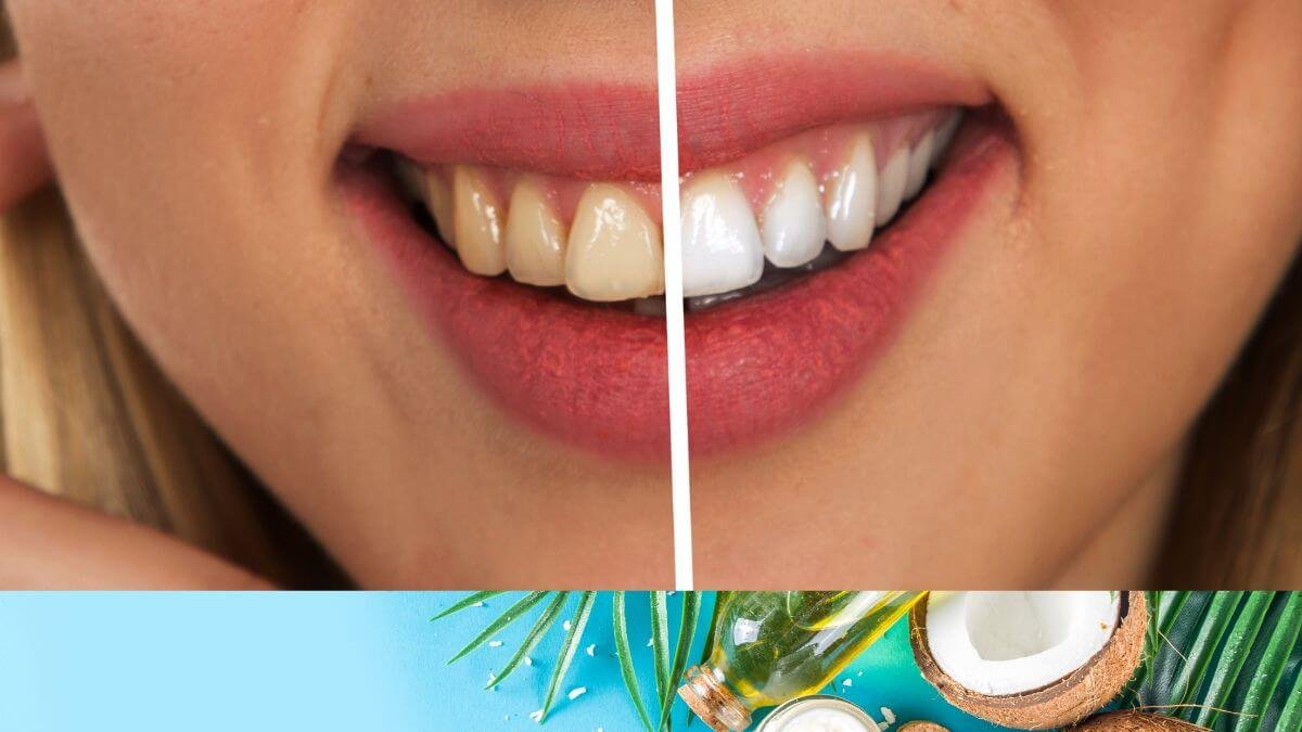 does coconut oil whiten teeth 6